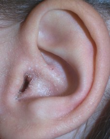 Eczema_ear2