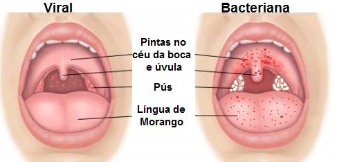 Dor de Garganta na Criança – PediatriaVirtual.com