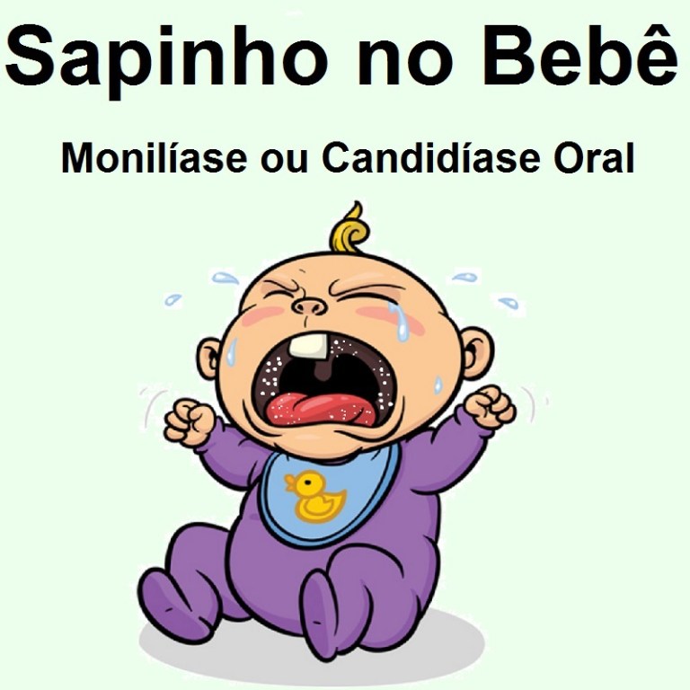 Sapinho – Monilíase ou Candidíase Oral – PediatriaVirtual.com